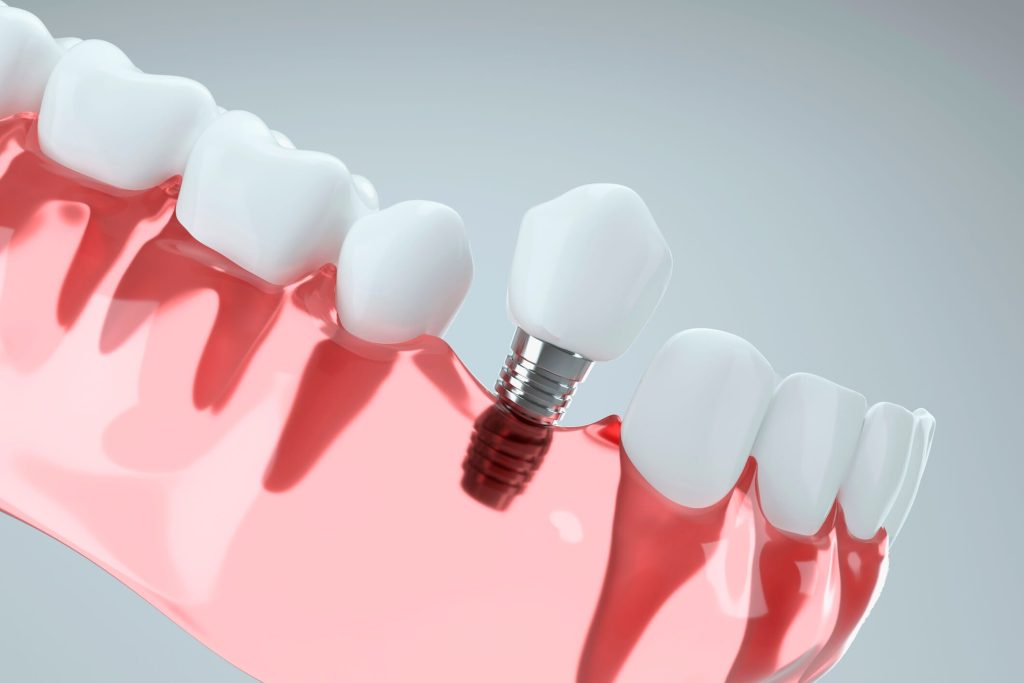 A 3D image of a tooth implant going into the jawbone.