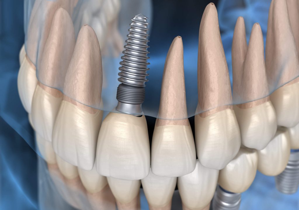 3D illustration of a single endosteal implant