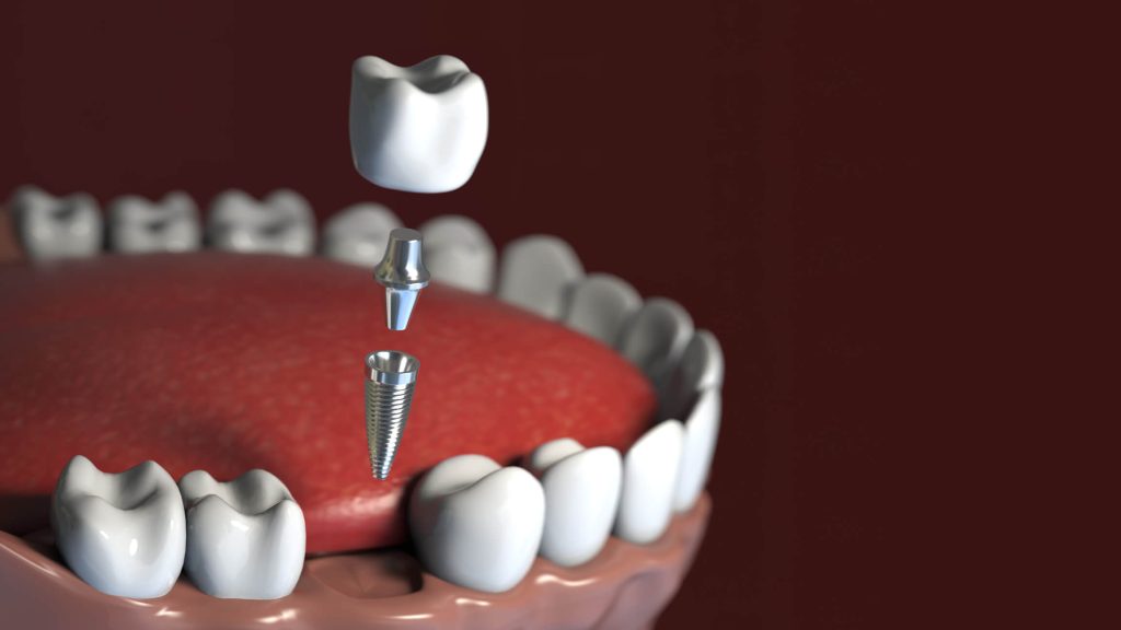 Dental implant installation