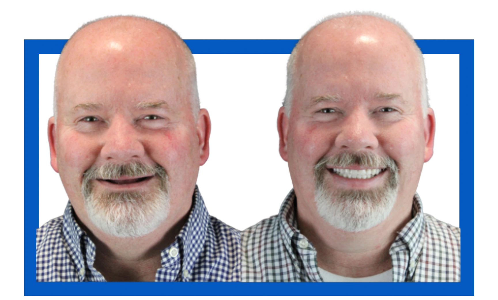 Brian Before After Dentures