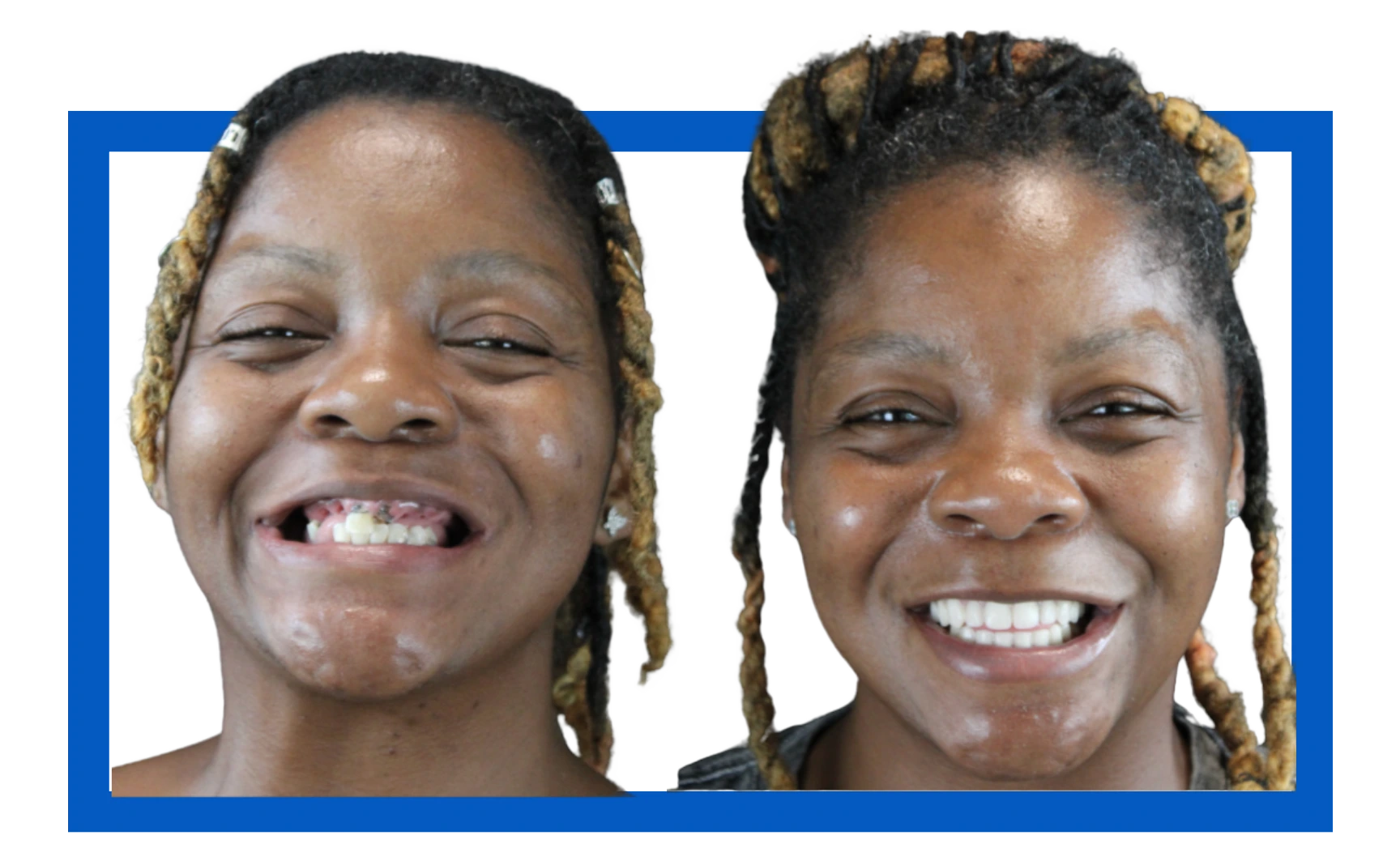 Casidee Before After Dental Implants