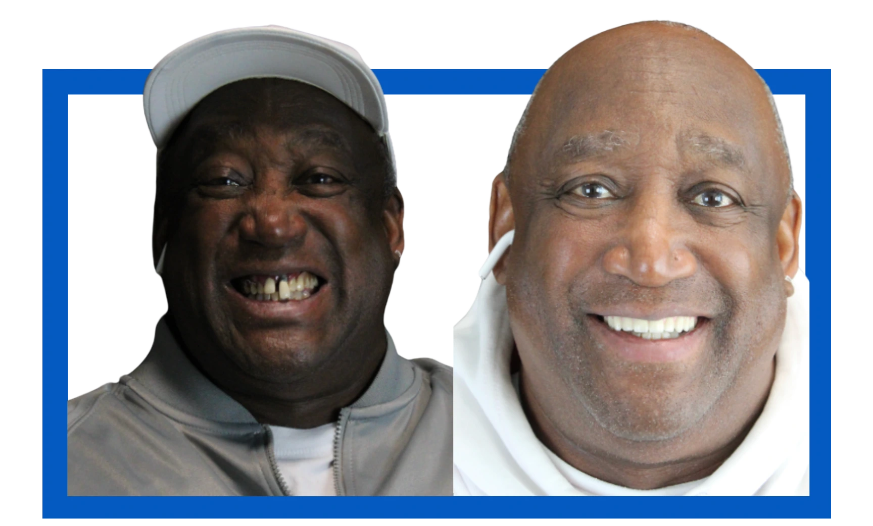 Brian Before After Dentures
