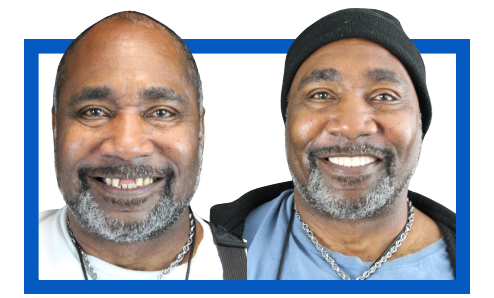 Tim Before After Dentures